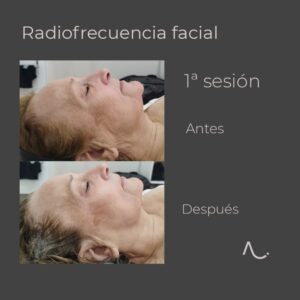 Diatermia facial Bono 6 sesiones 250€